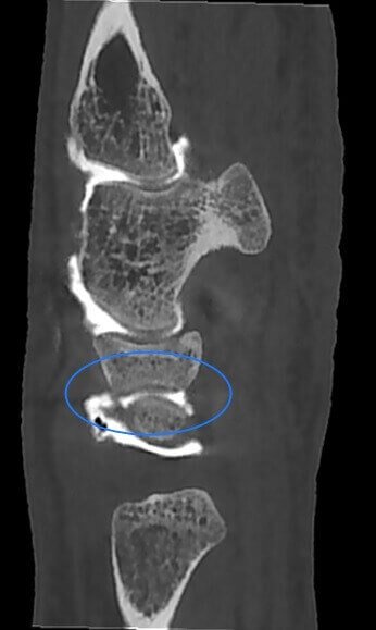 ARTHRO CBCT: Broken Ligament Lunate–Triquetrum