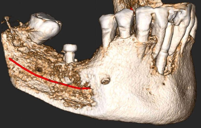 Lower Jaw: Implants and Bone tumor. IAN evaluation