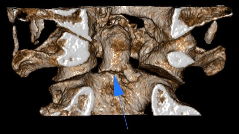 Cervical Spine: Dens fracture-Type II