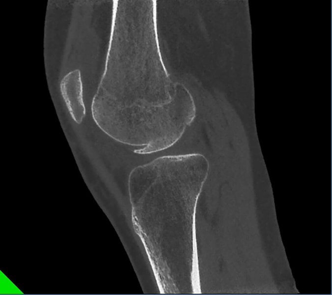Lateral femoral condile fracture