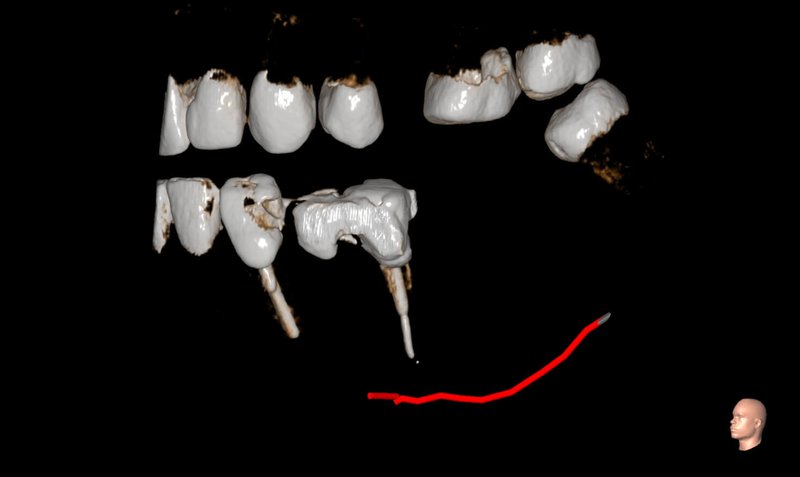 Evaluation of an old Endodontic treatment