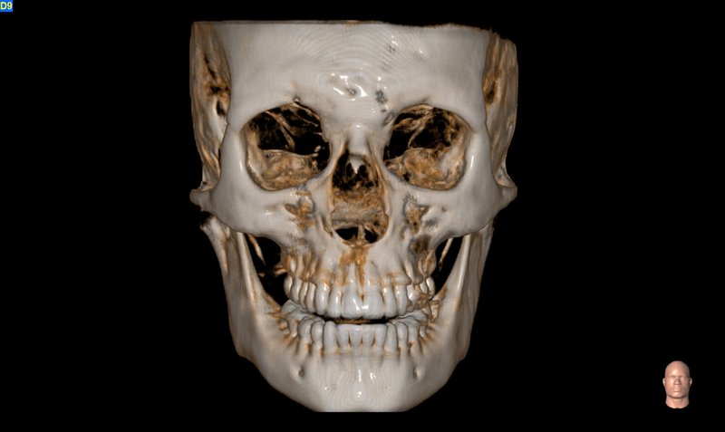 Maxillofacial acquisition and Airways evaluation (MXF)