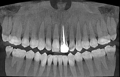 Endodontic treatment in Incisor 2.1