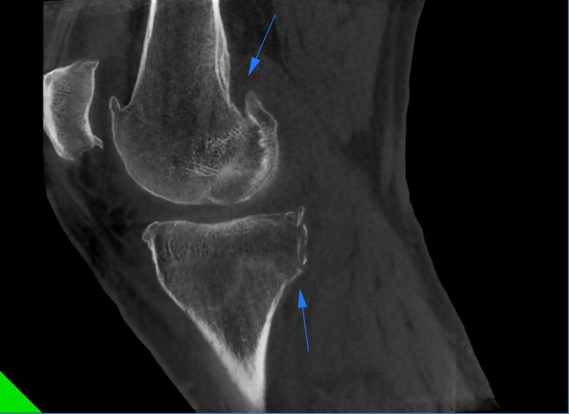 Knee Multiple fractures