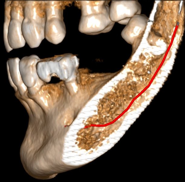 Valutazione di un vecchio trattamento endodontico