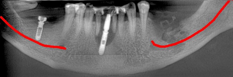 Lower Jaw: Implants and Bone tumor. IAN evaluation