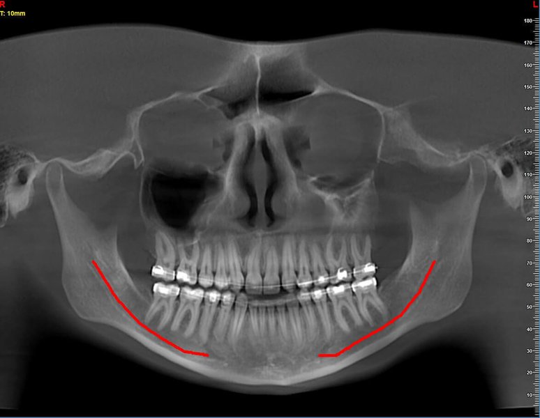Acquisizione Maxillofacciale per trattamento Ortodontico e Ortognatico