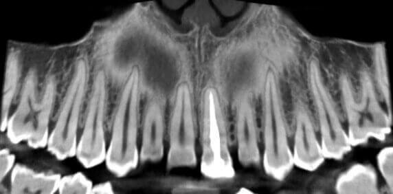 Endodontic treatment in Incisor 2.1