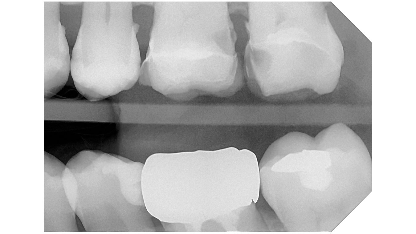 DCIS_CARIES REVEALING_1080x608