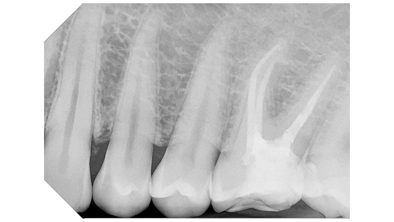 DCIS_SOFT TISSUE PRESERVING_1080x608