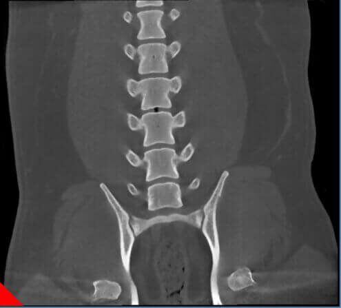 5G XL VET_Immagini Diagnostiche_Ernia del disco lombare_1