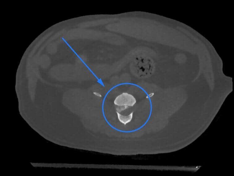 5G XL VET_Immagini Diagnostiche_Ernia del disco lombare_4