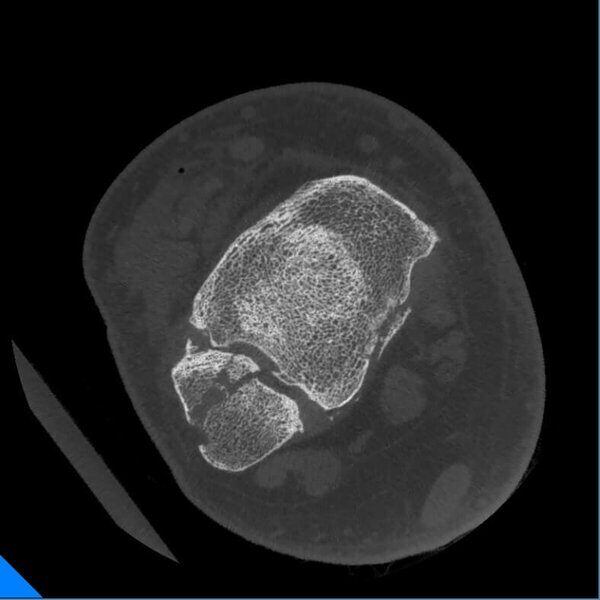 5G XL MED_Immagini Diagnostiche_ARTI SUPERIORI E INFERIORI_CAVIGLIA_Lesione Osteocondrale in paziente con mezzo di Osteosintesi