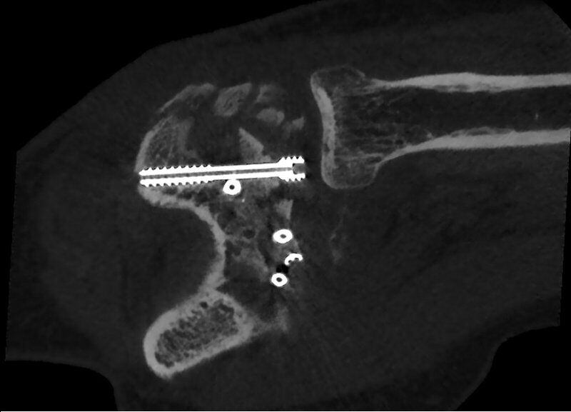 5G XL MED_Immagini Diagnostiche_ARTI SUPERIORI E INFERIORI_GOMITO_Frattura di Capitulum e Troclea con mezzo di Osteosintesi