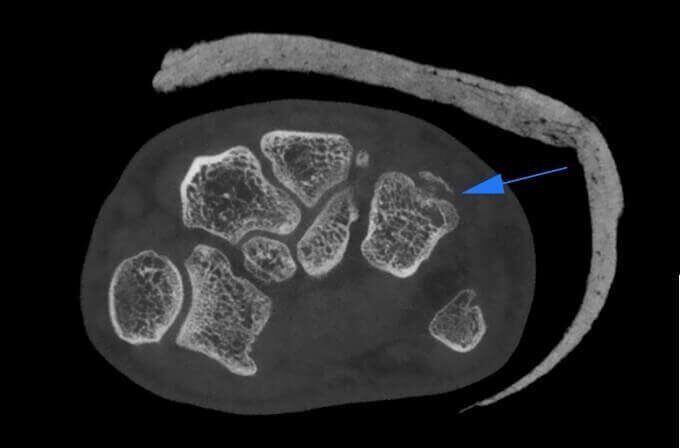 5G XL MED_Immagini Diagnostiche_ARTI SUPERIORI E INFERIORI_MANI_Microfrattura di osso Unciforme_1