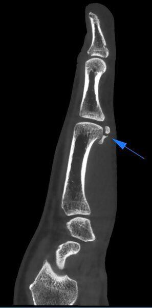 5G XL MED_Immagini Diagnostiche_ARTI SUPERIORI E INFERIORI_PIEDE_Frattura di osso sesamoide_2