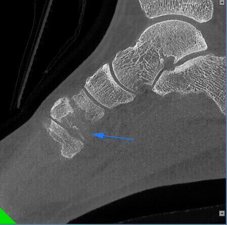 5G XL MED_Immagini Diagnostiche_ARTI SUPERIORI E INFERIORI_PIEDE_Microfratture di Scafoide_1