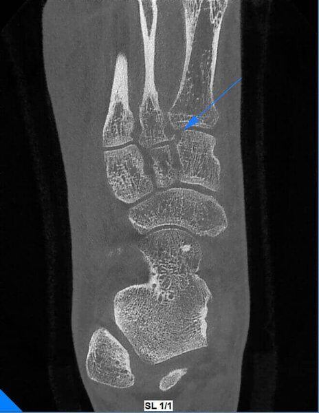 5G XL MED_Immagini Diagnostiche_ARTI SUPERIORI E INFERIORI_PIEDE_Microfratture di Scafoide_2