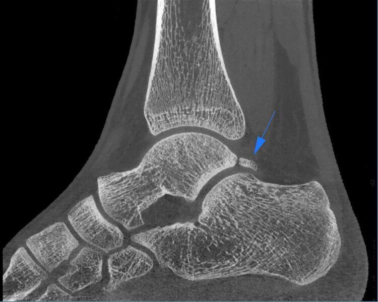 5G XL MED_Immagini Diagnostiche_ARTI SUPERIORI E INFERIORI_PIEDE_Os Trigonum_1