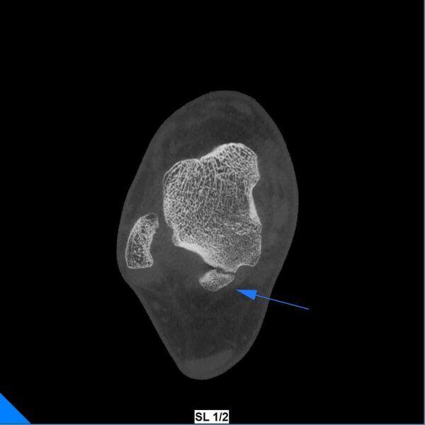 5G XL MED_Immagini Diagnostiche_ARTI SUPERIORI E INFERIORI_PIEDE_Os Trigonum_2
