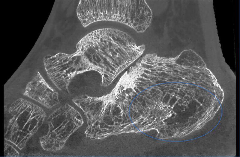 5G XL MED_Immagini Diagnostiche_ARTI SUPERIORI E INFERIORI_PIEDE_Osteonecrosi del calcagno_1