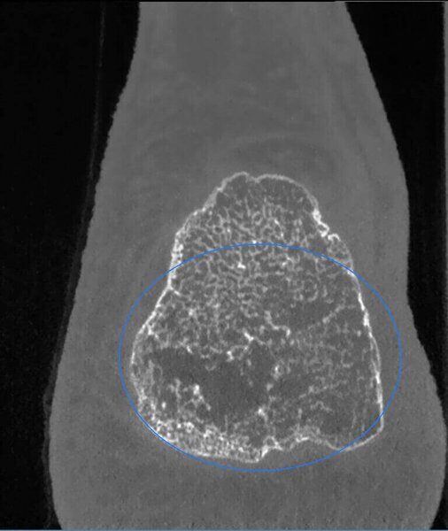 5G XL MED_Immagini Diagnostiche_ARTI SUPERIORI E INFERIORI_PIEDE_Osteonecrosi del calcagno_3