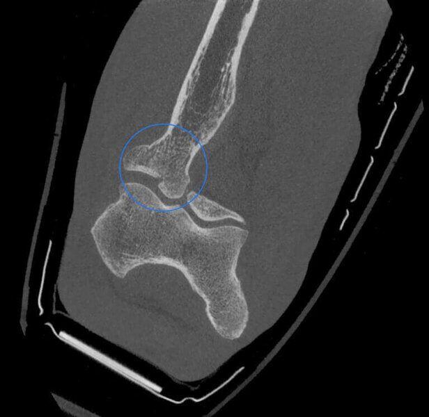 5G XL MED_Immagini Diagnostiche_ARTI SUPERIORI E INFERIORI_POLSO_Frattura della testa del Radio in paziente con gesso_2