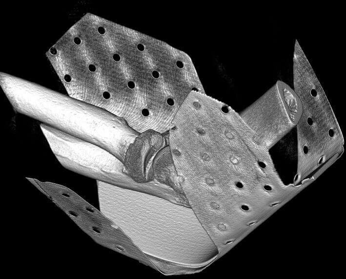 5G XL MED_Immagini Diagnostiche_ARTI SUPERIORI E INFERIORI_POLSO_Frattura della testa del Radio in paziente con gesso_5