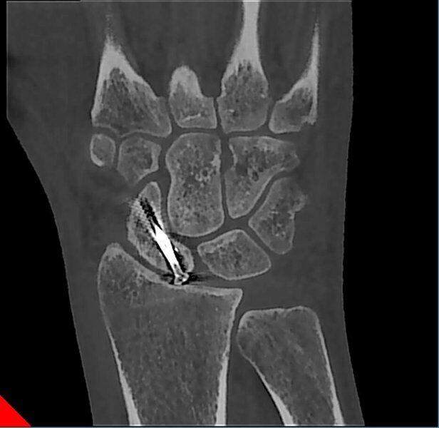 5G XL MED_Immagini Diagnostiche_ARTI SUPERIORI E INFERIORI_POLSO_Frattura di Scafoide mezzo di Osteosintesi_1