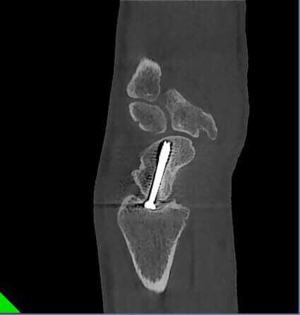 5G XL MED_Immagini Diagnostiche_ARTI SUPERIORI E INFERIORI_POLSO_Frattura di Scafoide mezzo di Osteosintesi_2