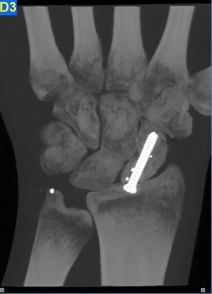 5G XL MED_Immagini Diagnostiche_ARTI SUPERIORI E INFERIORI_POLSO_Frattura di Scafoide mezzo di Osteosintesi_3