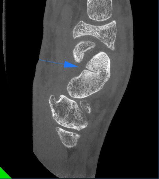 5G XL MED_Immagini Diagnostiche_ARTI SUPERIORI E INFERIORI_POLSO_Frattura di Scafoide_2