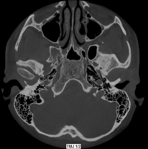 5G XL MED_Immagini Diagnostiche_TESTA E COLLO_ARTICOLAZIONE TEMPORO-MANDIBOLARE_ATM Bocca Aperta_1