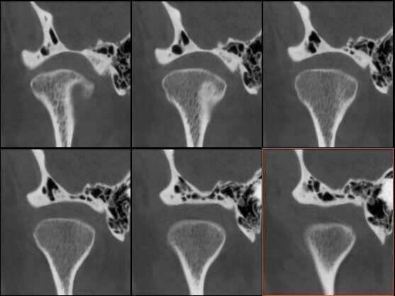5G XL MED_Immagini Diagnostiche_TESTA E COLLO_ARTICOLAZIONE TEMPORO-MANDIBOLARE_ATM Bocca Aperta_2
