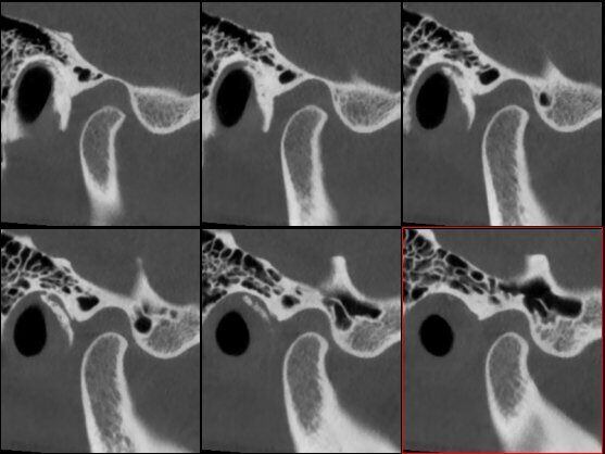 5G XL MED_Immagini Diagnostiche_TESTA E COLLO_ARTICOLAZIONE TEMPORO-MANDIBOLARE_ATM Bocca Aperta_3