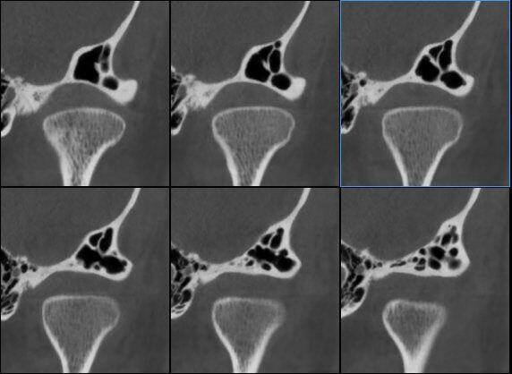 5G XL MED_Immagini Diagnostiche_TESTA E COLLO_ARTICOLAZIONE TEMPORO-MANDIBOLARE_ATM Bocca Aperta_4