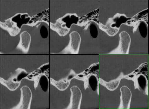 5G XL MED_Immagini Diagnostiche_TESTA E COLLO_ARTICOLAZIONE TEMPORO-MANDIBOLARE_ATM Bocca Aperta_5