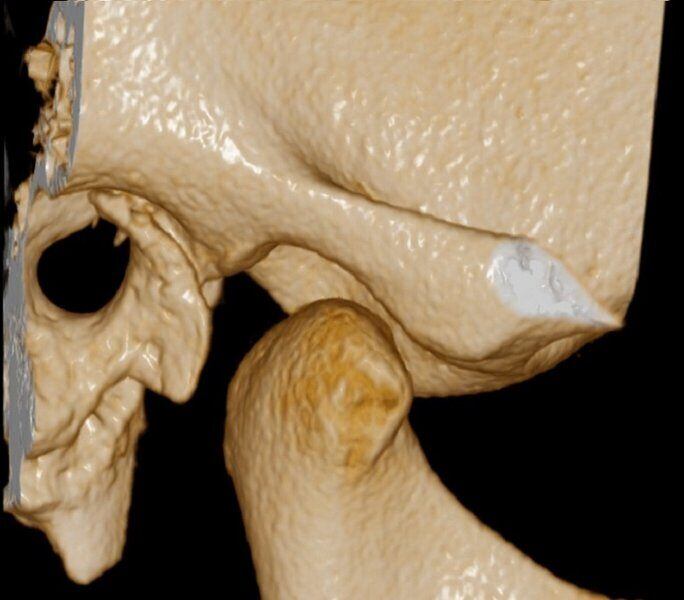 5G XL MED_Immagini Diagnostiche_TESTA E COLLO_ARTICOLAZIONE TEMPORO-MANDIBOLARE_ATM Bocca Aperta_6