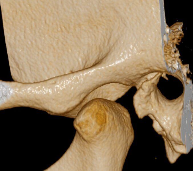 5G XL MED_Immagini Diagnostiche_TESTA E COLLO_ARTICOLAZIONE TEMPORO-MANDIBOLARE_ATM Bocca Aperta_7