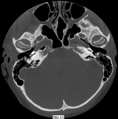 5G XL MED_Immagini Diagnostiche_TESTA E COLLO_ARTICOLAZIONE TEMPORO-MANDIBOLARE_ATM Bocca Chiusa_1