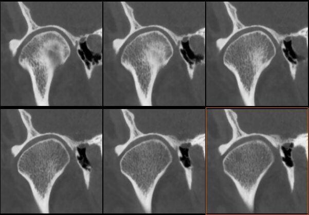5G XL MED_Immagini Diagnostiche_TESTA E COLLO_ARTICOLAZIONE TEMPORO-MANDIBOLARE_ATM Bocca Chiusa_2