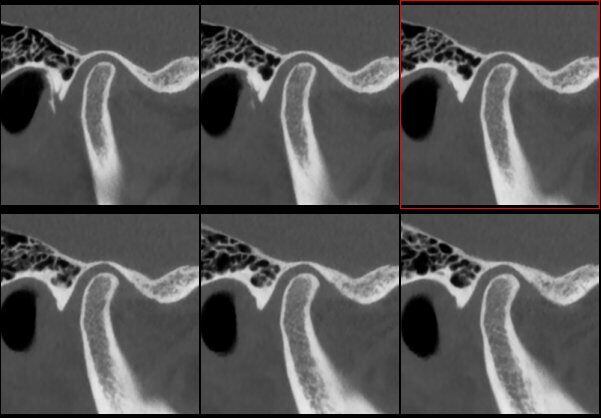 5G XL MED_Immagini Diagnostiche_TESTA E COLLO_ARTICOLAZIONE TEMPORO-MANDIBOLARE_ATM Bocca Chiusa_3