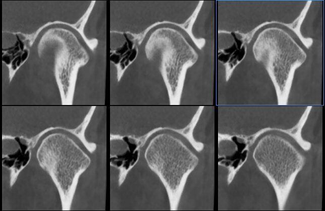5G XL MED_Immagini Diagnostiche_TESTA E COLLO_ARTICOLAZIONE TEMPORO-MANDIBOLARE_ATM Bocca Chiusa_4