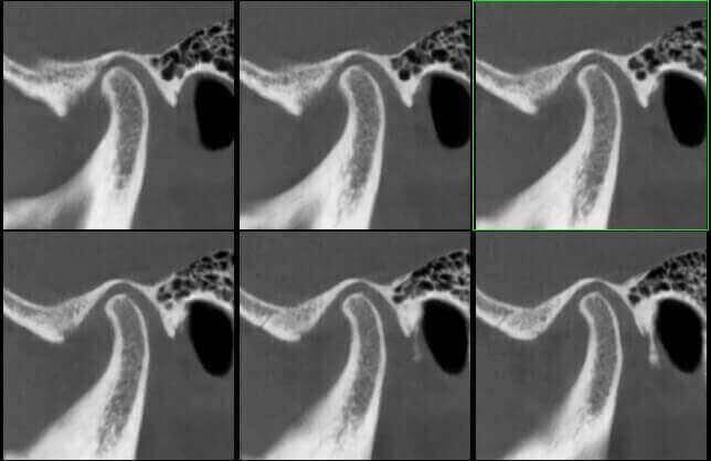 5G XL MED_Immagini Diagnostiche_TESTA E COLLO_ARTICOLAZIONE TEMPORO-MANDIBOLARE_ATM Bocca Chiusa_5