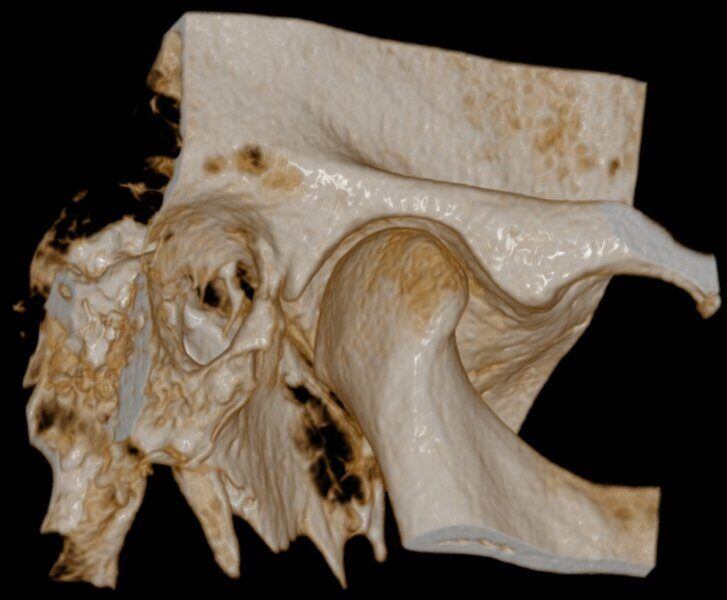 5G XL MED_Immagini Diagnostiche_TESTA E COLLO_ARTICOLAZIONE TEMPORO-MANDIBOLARE_ATM Bocca Chiusa_6