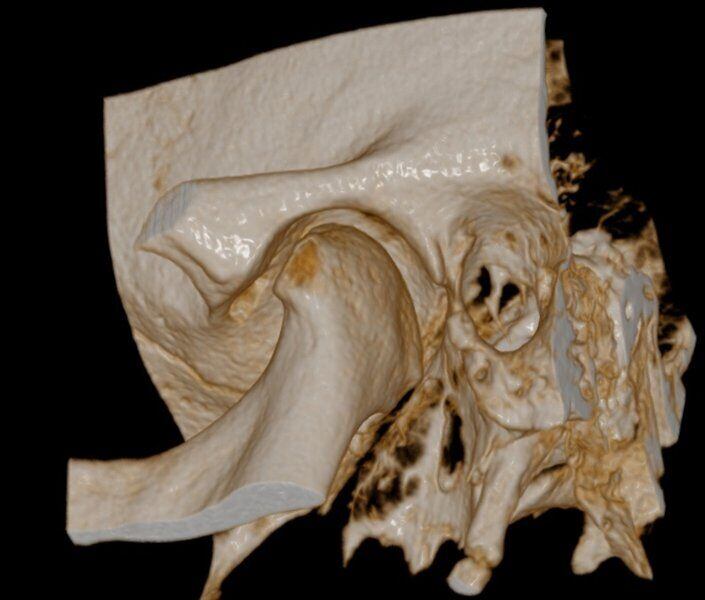 5G XL MED_Immagini Diagnostiche_TESTA E COLLO_ARTICOLAZIONE TEMPORO-MANDIBOLARE_ATM Bocca Chiusa_7