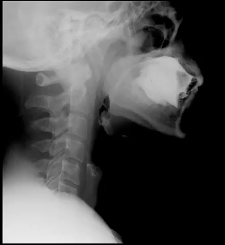 5G XL MED_Immagini Diagnostiche_TESTA E COLLO_DENTIZIONE_CINEX_Deglutizione