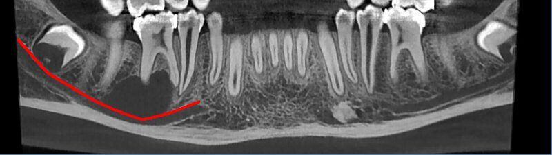 5G XL MED_Immagini Diagnostiche_TESTA E COLLO_DENTIZIONE_Cisti mandibolare in Q4_1
