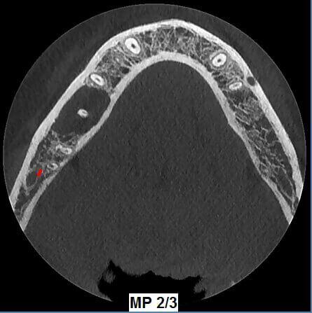 5G XL MED_Immagini Diagnostiche_TESTA E COLLO_DENTIZIONE_Cisti mandibolare in Q4_2