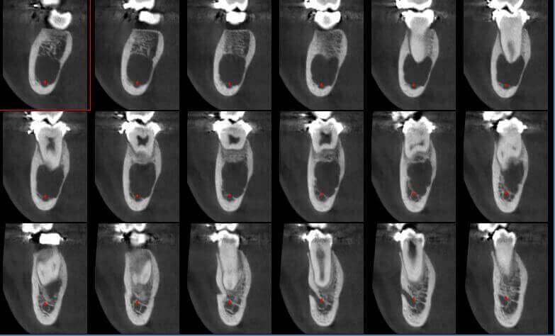 5G XL MED_Immagini Diagnostiche_TESTA E COLLO_DENTIZIONE_Cisti mandibolare in Q4_3